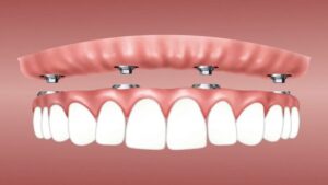 Restore Your Smile with Dental Implants in Leek