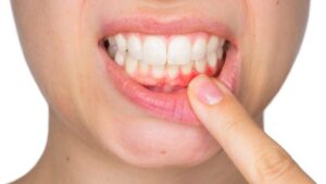 Ultimate Gum Disease Treatment: Restore Your Smile