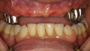 Revolutionizing Smiles: The Power of Tooth Implants