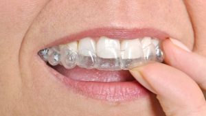 Invisalign Lite vs. Full: Which is Right for You?