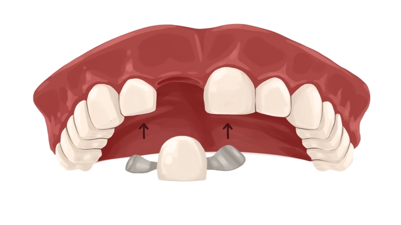 cantilever dental bridge