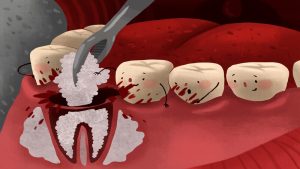 Dental Bone Grafting: What it is and How it Works?