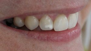 Annoying White Spots on Your Teeth? Our Solutions Await