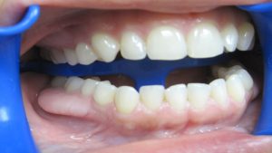 Curious About Veneers? Learn Why They’re the Ultimate Solution for a Perfect Smile