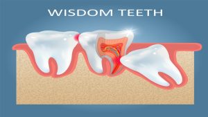 How to Manage and Treat Impacted Wisdom Teeth?