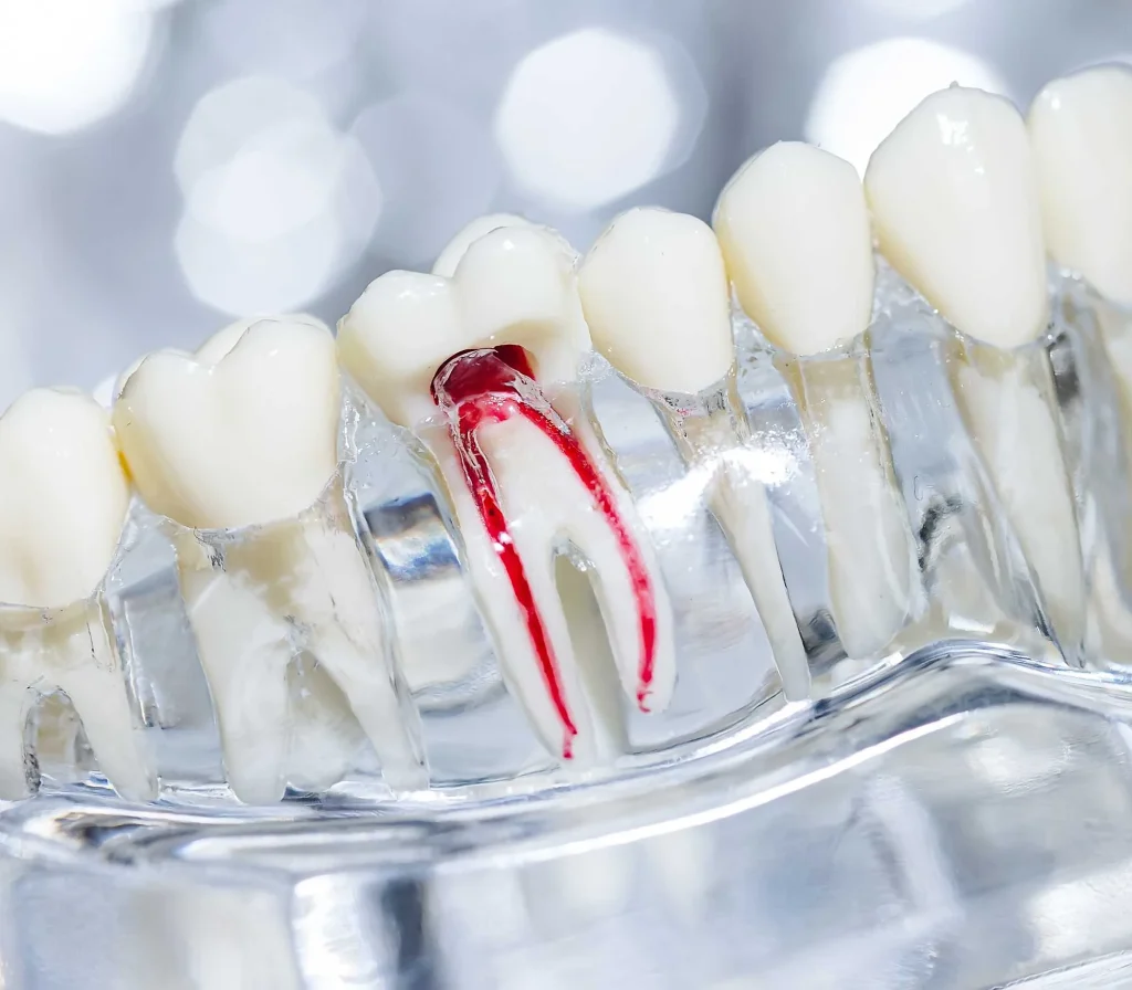 Root Canal Treatment in Leek